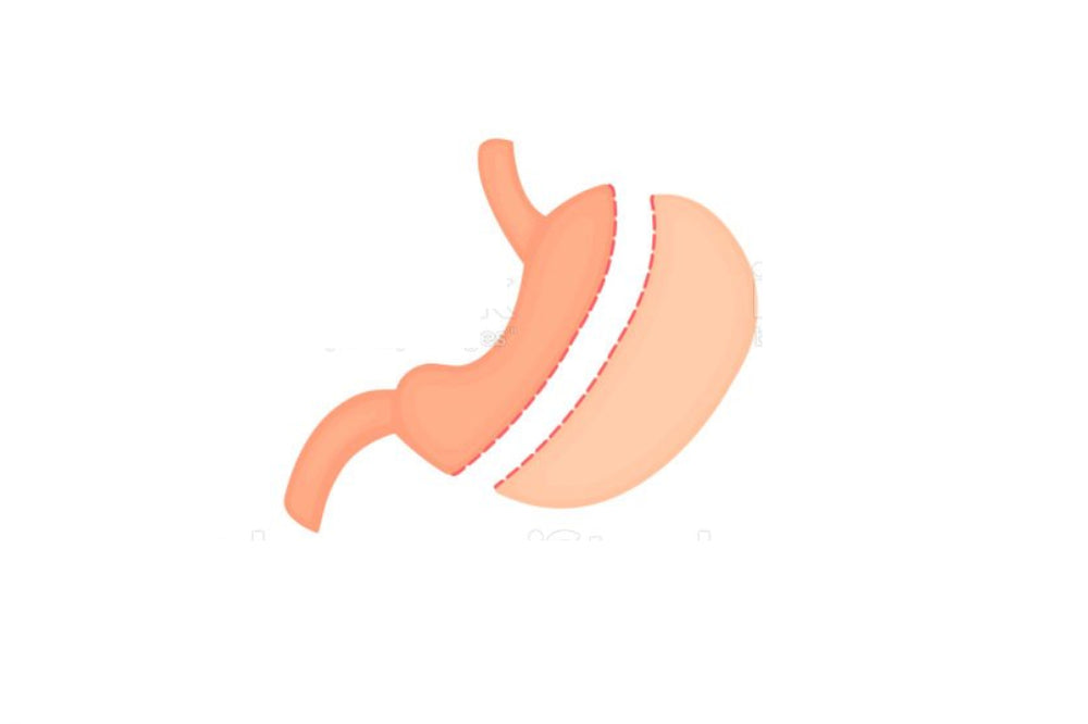 Weight Loss Surgery Scotland